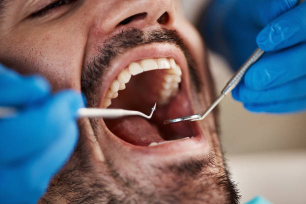 Best Knocked-Out Tooth (Avulsed Tooth) Treatment in Shiremanstown, PA